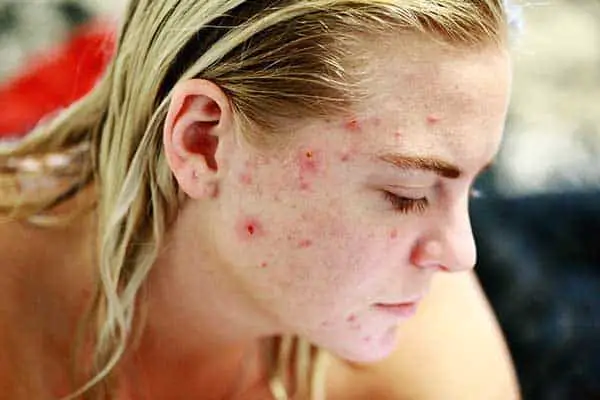 traitements naturels acné