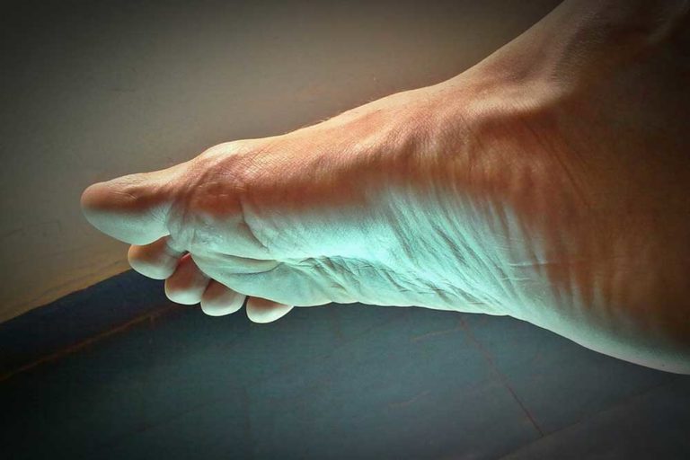 prevenir-soigner-hallux-valgus